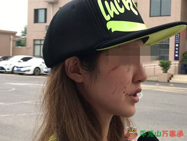 女主播自曝遛狗未拴绳遭暴打 脸部多处伤口